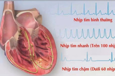 Tư vấn: Nhịp tim thường xuyên 90 nhịp/phút có làm sao không?