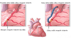 Tư vấn: Khi nào thì cần phẫu thuật bắc cầu nối chủ - vành