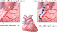 Tư vấn: Khi nào thì cần phẫu thuật bắc cầu nối chủ - vành