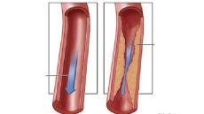 Tư vấn: Phòng ngừa bệnh hẹp động mạch vành