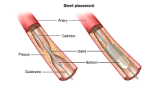 Tư vấn: Stent động mạch vành là gì?