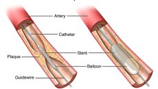 Tư vấn: Stent động mạch vành là gì?