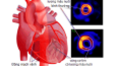 Thiếu máu cục bộ cơ tim và các biến chứng