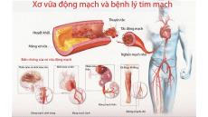 Bệnh hẹp mạch vành có thể khỏi sau vài tháng