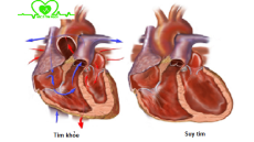 Bệnh suy tim có chữa được không?