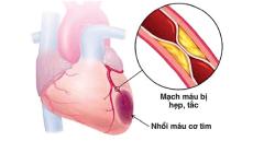 Tổng quan về bệnh thiếu máu cơ tim thầm lặng nguy hiểm