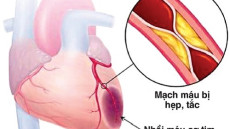 Tổng quan về bệnh thiếu máu cơ tim thầm lặng nguy hiểm
