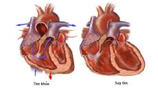 Những biến chứng thường gặp của bệnh suy tim và cách phòng tránh hiệu quả