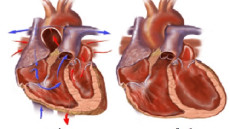 Những biến chứng thường gặp của bệnh suy tim và cách phòng tránh hiệu quả