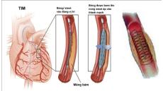 Cách hỗ trợ chữa hẹp tắc động mạch vành: Nên uống thuốc, đặt stent hay phẫu thuật?