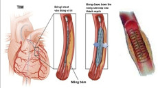 Cách hỗ trợ chữa hẹp tắc động mạch vành: Nên uống thuốc, đặt stent hay phẫu thuật?