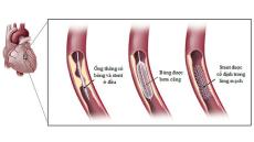 Chi phí đặt stent mạch vành bao nhiêu tiền?