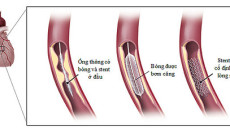 Chi phí đặt stent mạch vành bao nhiêu tiền?