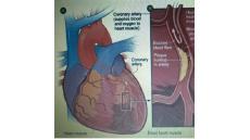 Chụp và can thiệp động mạch vành qua da