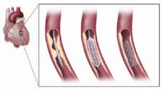 Đặt stent có nguy hiểm không?