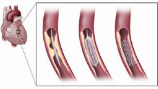 Đặt stent có nguy hiểm không?