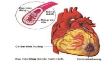 Tầm quan trọng của điện tâm đồ nhồi máu cơ tim và hình ảnh của chúng