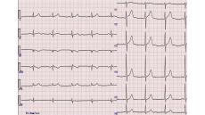 Điện tâm đồ là gì? Những đối tượng cần làm điện tâm đồ?