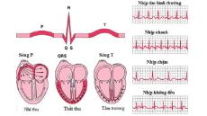 Điện tâm đồ trong bệnh thiếu máu cơ tim