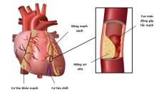 Giải pháp nào cho người mắc bệnh tim mạch ?