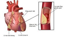 Hẹp mạch vành có làm người mệt mỏi không?