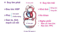 Những hiểu biết cơ bản về suy tim phải bạn nên biết