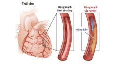 Tìm hiểu về nguyên nhân và triệu chứng của bệnh suy tim trái
