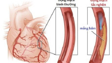 Tìm hiểu về nguyên nhân và triệu chứng của bệnh suy tim trái