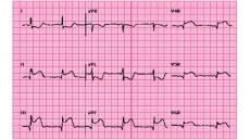 Tính mạng “ngàn cân treo sợi tóc” khi bị nhồi máu cơ tim thất phải
