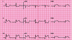 Tính mạng “ngàn cân treo sợi tóc” khi bị nhồi máu cơ tim thất phải