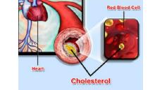 Rối loạn mỡ máu, yếu tố nguy cơ bệnh mạch vành, huyết áp cao