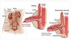 Bệnh cao huyết áp ở người trẻ tuổi có nguy hiểm không?