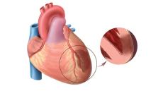 Báo động bệnh thiếu máu cơ tim ở người trẻ và giải pháp điều trị hiệu quả