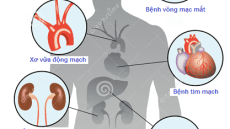 Bệnh tiểu đường và các cách phòng ngừa