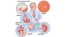 Biến chứng nguy hiểm của tăng huyết áp đến tim mạch