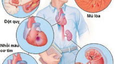 Biến chứng nguy hiểm của tăng huyết áp đến tim mạch