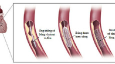 Các loại stent mạch vành bạn nên biết