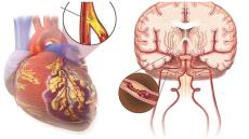 Cách phòng chống đột quỵ ai cũng nên biết