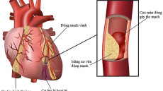 Bệnh hẹp mạch vành và những điều nên biết