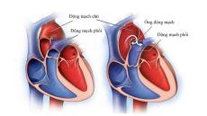 Động mạch là gì? Cấu tạo và chức năng của hệ thống động mạch
