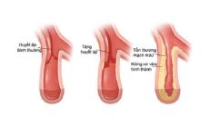 Làm sao để hết xơ vữa động mạch