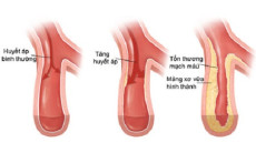 Làm sao để hết xơ vữa động mạch
