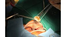 Những kiến thức cơ bản giúp theo dõi lâu dài hoạt động của van tim nhân tạo