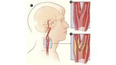 Canh cánh nỗi lo liệt nửa người vì xơ vữa động mạch cảnh