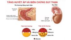 Cao huyết áp và những tác động cực kì nguy hiểm cần biết