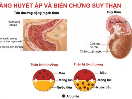 Cao huyết áp và những tác động cực kì nguy hiểm cần biết