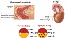 Cao huyết áp và những tác động cực kì nguy hiểm cần biết