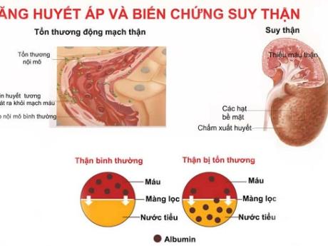 Cao huyết áp và những tác động cực kì nguy hiểm cần biết
