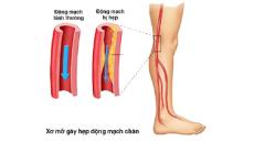 Xơ vữa động mạch chi dưới - Cẩn thận nguy cơ cắt cụt chi