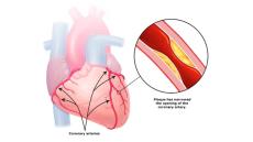 Bệnh thiếu máu cơ tim là gì?